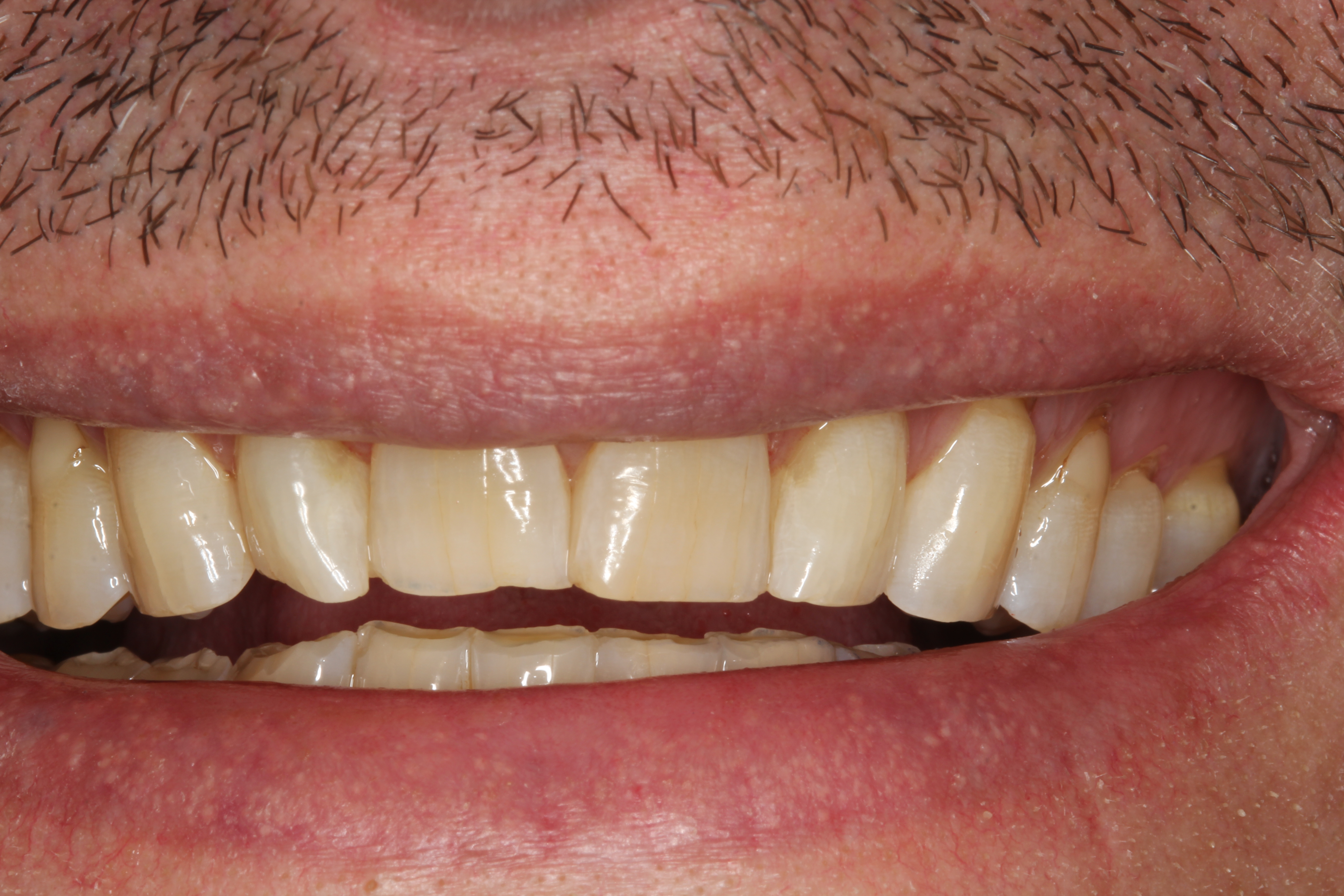Seamless Incisal Edge Repair Using Omnichroma Composite 